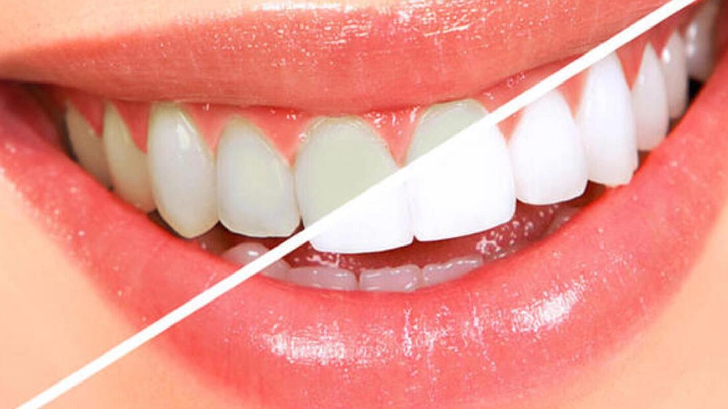 Diş beyazlatmak zararlı mı? Dişlerde hasar bırakır mı?