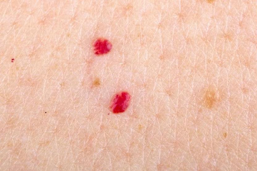 Cherry angioma on human skin